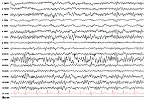 EEG mit einem Herdbefund: Darstellung des Herdbefundes