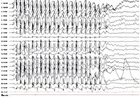 EEG mit Krampfaktivität (Spike-Wave-Komplexe)
