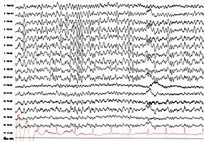 Verlangsamtes EEG