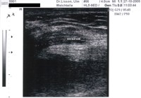 Nervus medianus im Ultraschall nach Verletzung